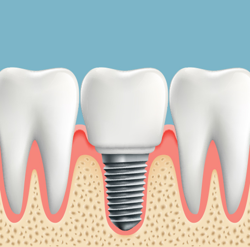 Illustration of Dental implant